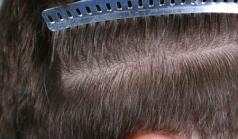 Before Hair Transplant&nbsp;Trichophytic Donor Scars